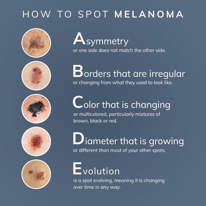 Do i have melanoma quiz