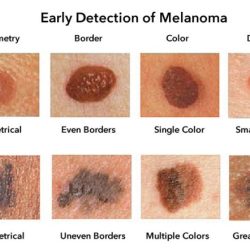 Do i have melanoma quiz