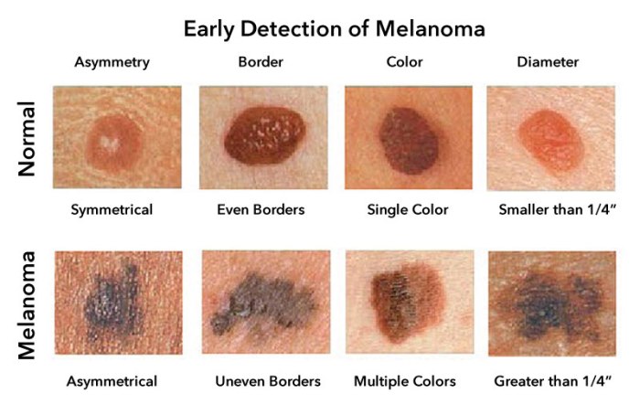 Do i have melanoma quiz